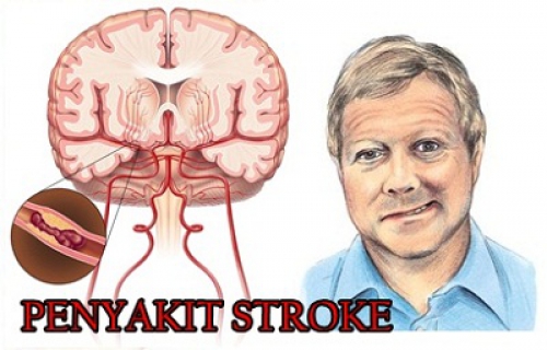 Stroke Bisa Dicegah, Ini 10 Caranya